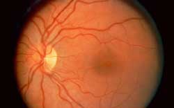 abnormal retina