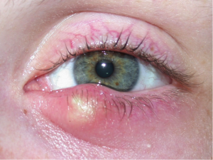 upper eyelid infection