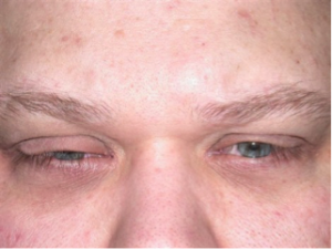 Orbital Emphysema: Can Make Your Eyelid Puffy