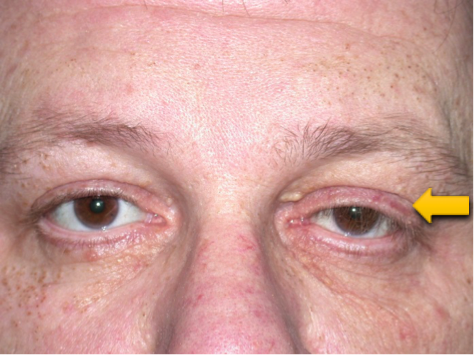 Floppy Eyelid Syndrome | Warwar Eye Group