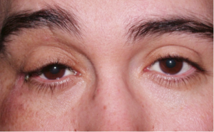 Should You Use Preparation H Under Eyes? | SELF