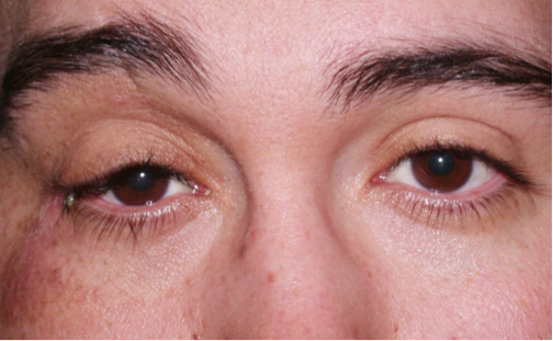 Floppy Eyelid Syndrome | Warwar Eye Group