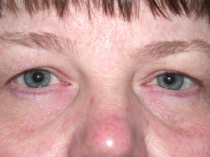 Eyelid Dermatitis Warwar Eye Group