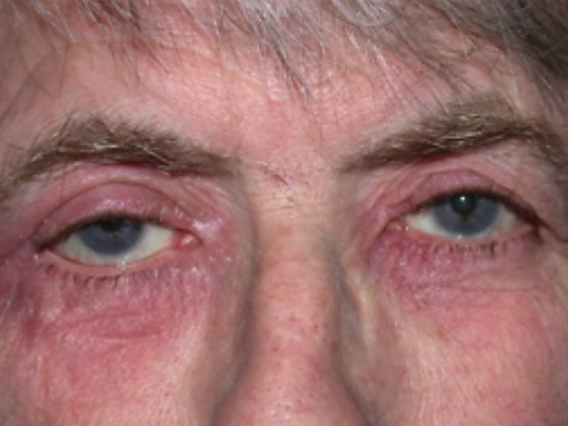 Eyelid Dermatitis - Warwar Eye Group