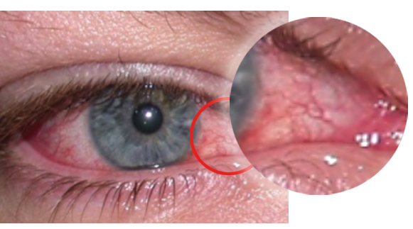 Subconjunctival Hemorrhage - Warwar Eye Group