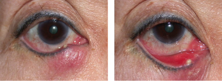 Eyelid Infections - Warwar Eye Group