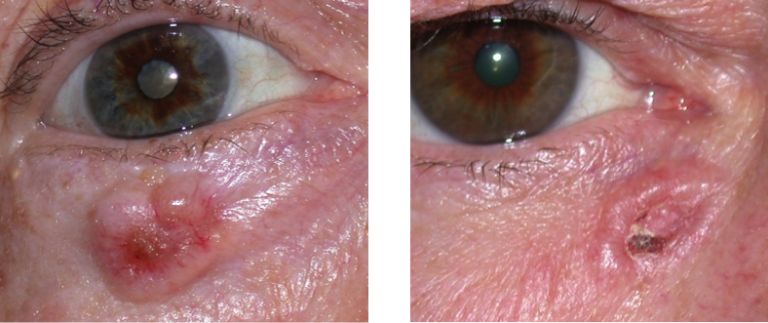 Eyelid Basal Cell Carcinoma Warwar Eye Group