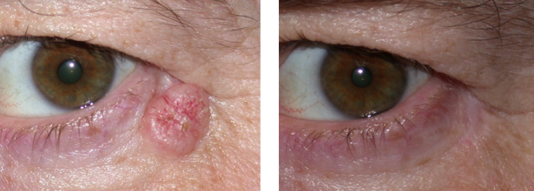 Eyelid Basal Cell Carcinoma Warwar Eye Group