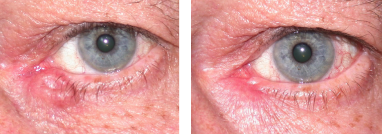 Eyelid Basal Cell Carcinoma Warwar Eye Group