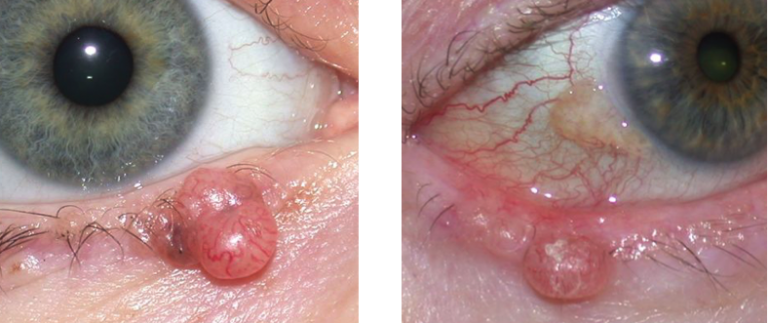 Eyelid Basal Cell Carcinoma Warwar Eye Group