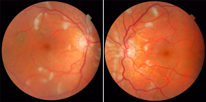 Immune System Disorders and the Eyes - Warwar Eye Group
