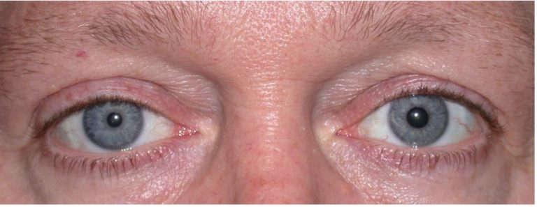 Horner’s Syndrome - Warwar Eye Group